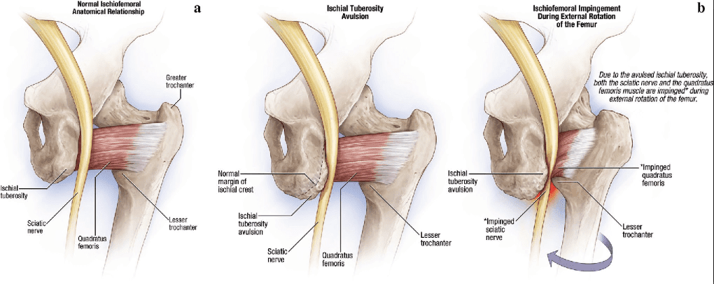 Síndrome ileo-femoral