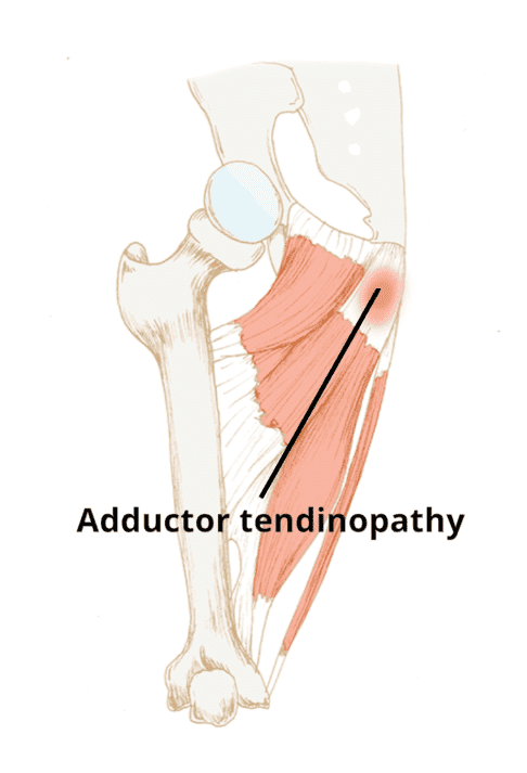 adductor tendinopathy diagram 2 | El Paso, TX Chiropractor