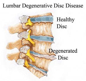 diagrama degenerativo de la enfermedad discal | El Paso, TX Quiropráctico