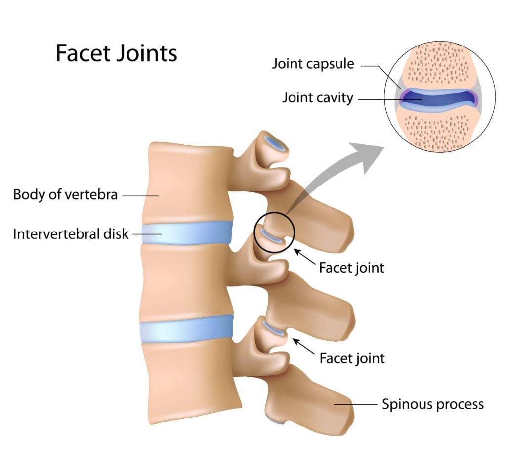 facet arthropathy diagram | El Paso, TX Chiropractor