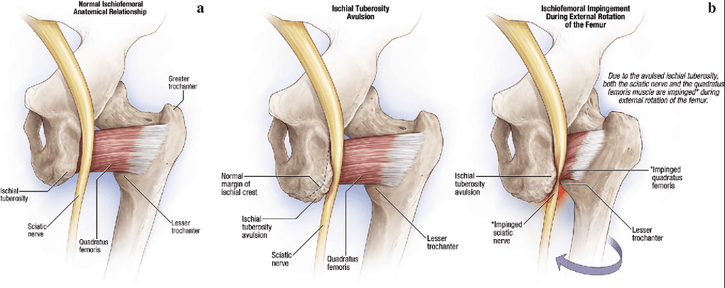 ischiofemoral impingement diagram 1 | El Paso, TX Chiropractor