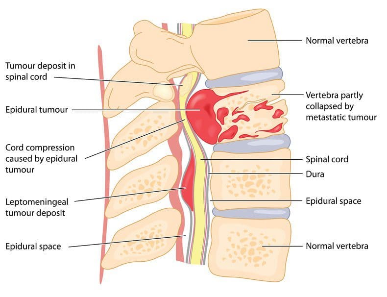 spinal tumor diagram | El Paso, TX Chiropractor