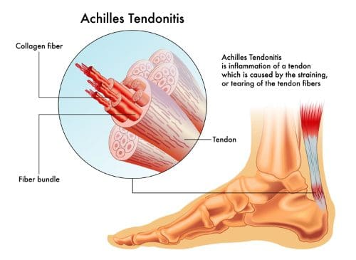 11860 Vista Del Sol, Ste. 128 Get Chiropractic Relief From Achilles Tendonitis El Paso, TX.