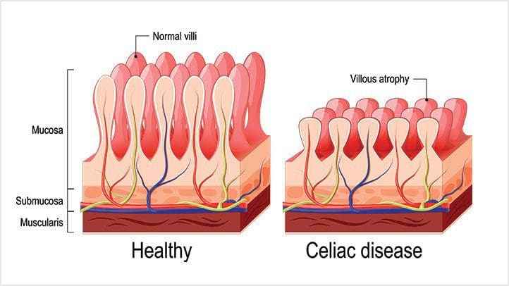 Celiac-Disease-Causes-and-Risk-Factors-alt-722x406