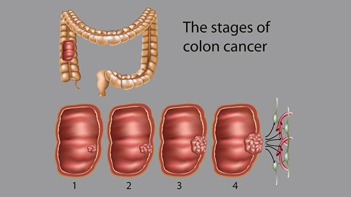 Colon-Cancer-What-do-the-Stages-Mean-722x406