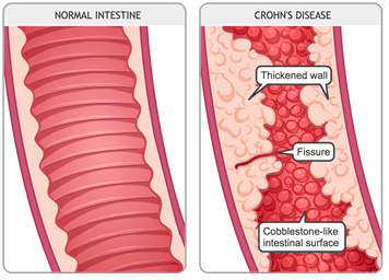 Crohns_disease_MED_ILL_EN