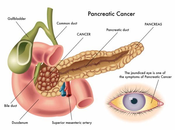 uspstf_pancreatic_cancer920.jpg.daijpg.600
