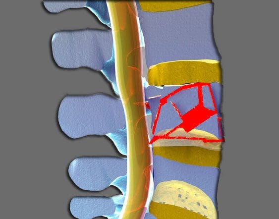 11860 Vista Del Sol, Ste. 128 Burst Fracture Injury, Diagnosis ug Pagtambal El Paso, TX.