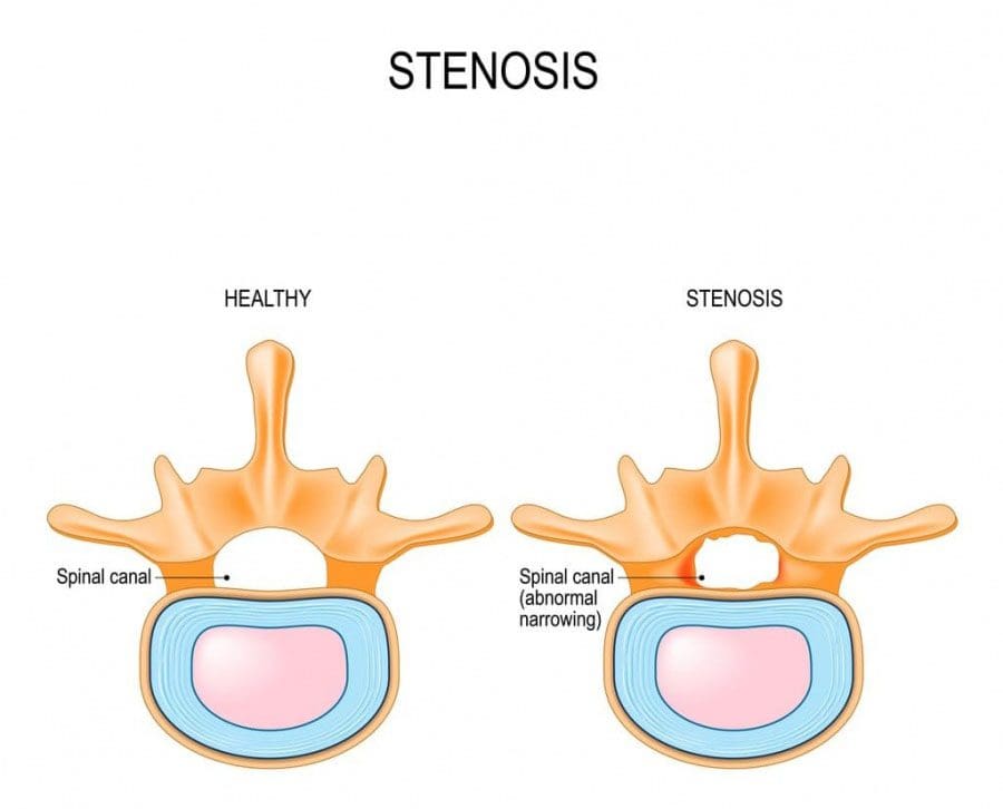 11860 Vista Del Sol, Ste. 128 Spinal Stenosis Causes and Prevention