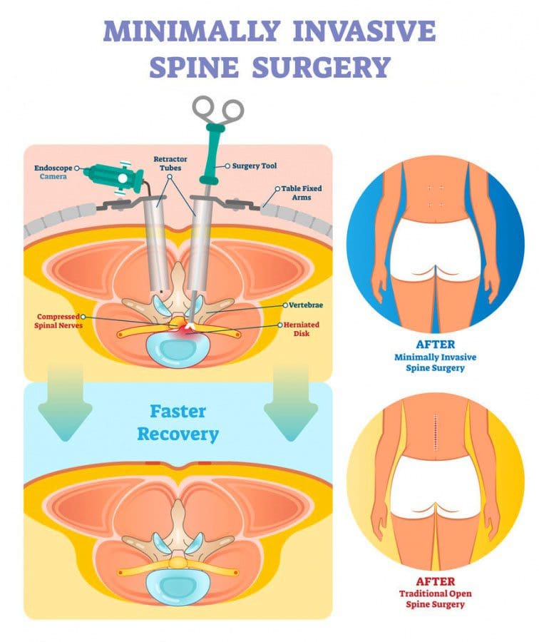 11860 Vista Del Sol, Ste. 128 How Does Minimally Invasive Spine Surgery Work?