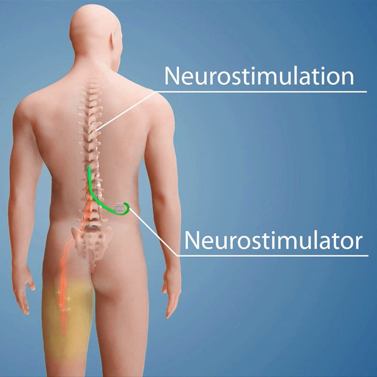 11860 Vista Del Sol, Ste. 128 Spinal Stimulation and Chronic Back Pain