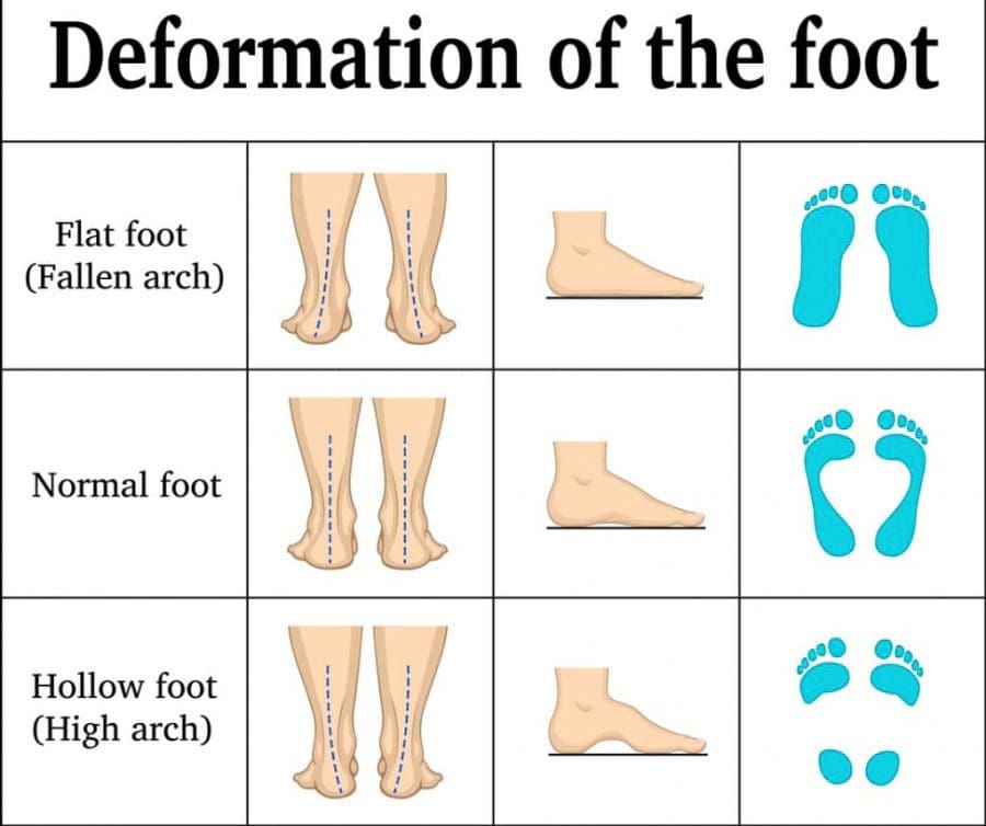 11860 Vista Del Sol, Ste. 128 Summer Footwear, Back Pain and What To Know