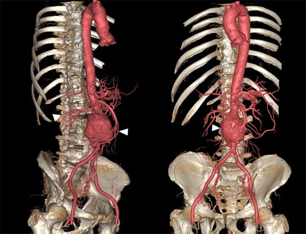 11860 Vista Del Sol, Ste. 128 Underlying Causes Of Abdominal Aneurysm and Sciatica