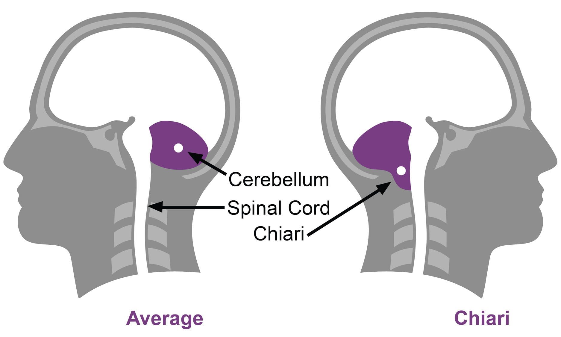 11860 Vista Del Sol, Ste. 128 Chiari Malformation Brain Tissue and The Spinal Canal