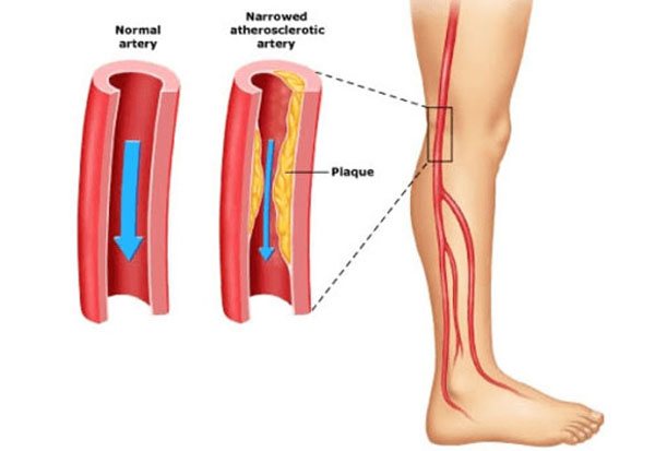 11860 Vista Del Sol, Ste. 128 Sciatica or Aneurysm, A Diagnostic Deadly Mistake!