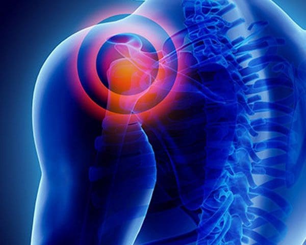 11860 Vista Del Sol, Ste. 128 Brachial Neuritis: Shoulder, Arm, Hand Pain, and Chiropractic Intervention