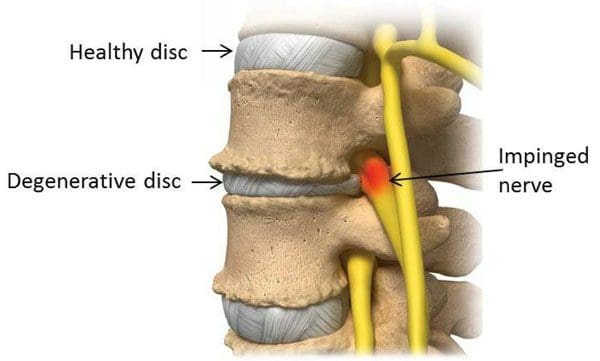 11860 Vista Del Sol, Ste. 128 Disc Pain and Nerve Root Pain Understanding Spinal Disc Problems