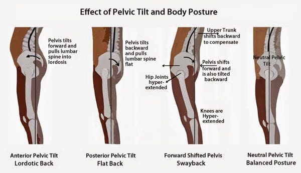 11860 Vista Del Sol, Ste. 128 Anterior/Posterior Pelvic Tilt Prevention with Chiropractic Foot Orthotics 