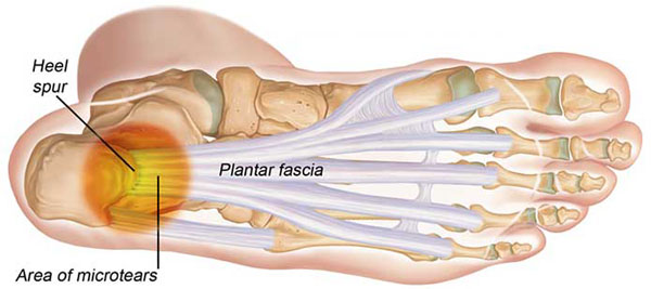 11860 Vista Del Sol, Ste. 128 Inflamed Plantar Fascia, Heel/Foot Pain, and Chiropractic