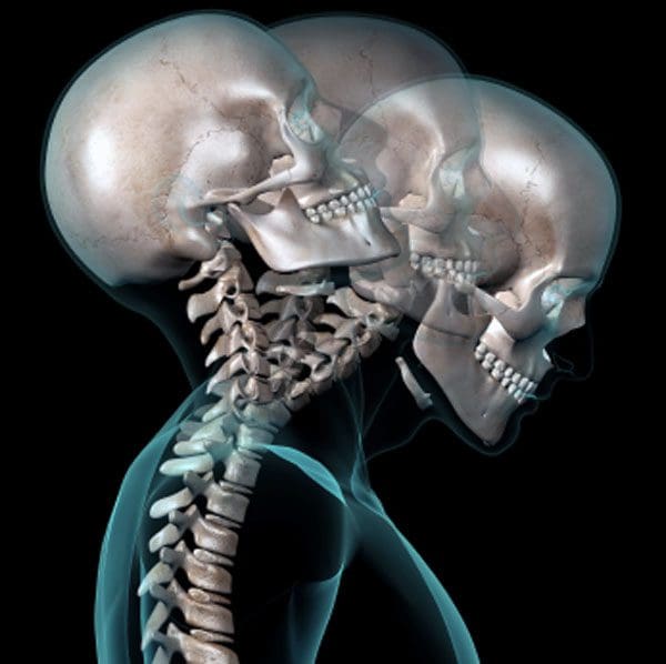 11860 Vista Del Sol, Ste. 128 Whiplash, Herniated Neck, Radiculopathy, and Chiropractic Relief