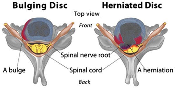11860 Vista Del Sol, Ste. 128 Spinal Disc Herniation Chiropractic Reset