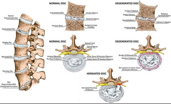 11860 Vista Del Sol, Ste. 128 Chiropractic Prevention and Relief For Degenerative Disc Disease