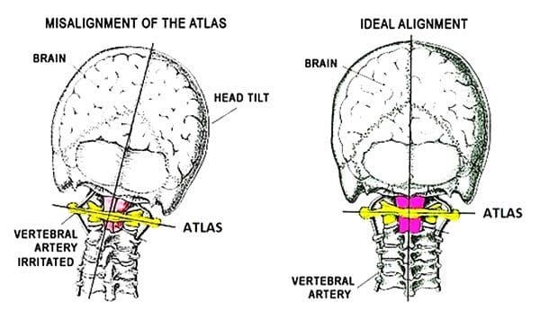 11860 Vista Del Sol, Ste. 128 La clave de la vértebra Atlas para mantener el equilibrio y la alineación de la cabeza