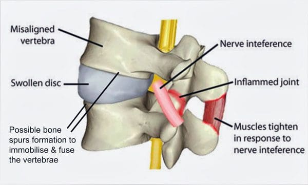 11860 Vista Del Sol, Ste. 128 Spinal Misalignments The Root Of Pain And Discomfort