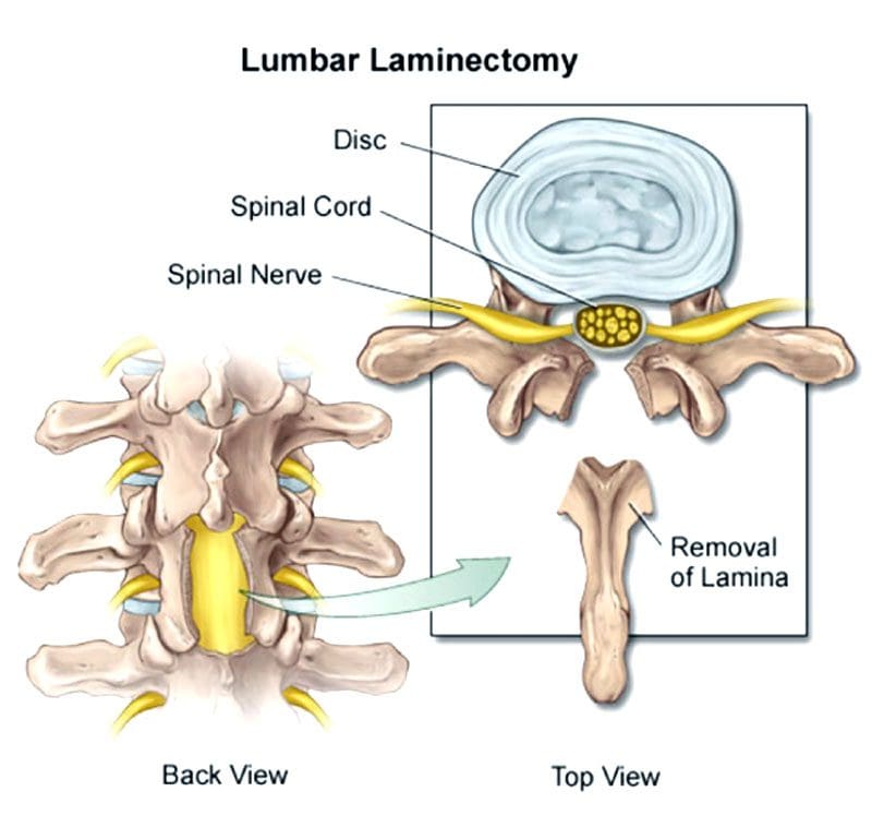 11860 Vista Del Sol, Ste. 128 Cirugía de descompresión espinal: laminotomía y laminectomía