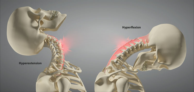 11860 Vista Del Sol, Ste. 128 Whiplash and Chronic Whiplash Injuries Following An Automobile Accident