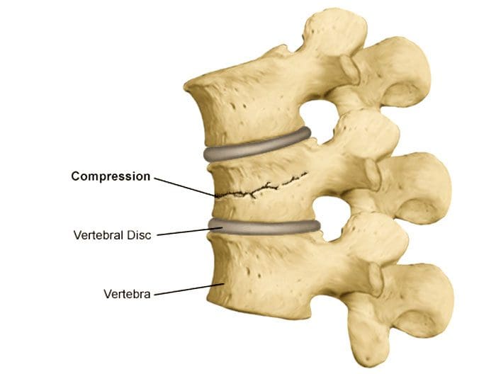 11860 Vista Del Sol, Ste. 128 Avoiding and Preventing Spinal Compression Fractures