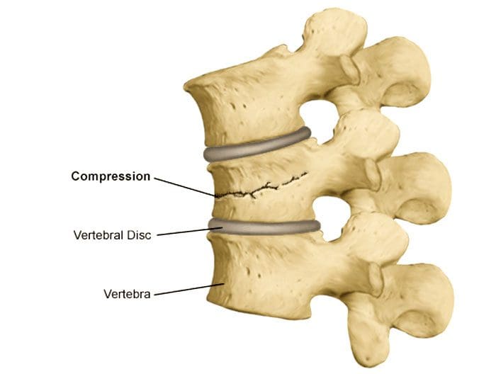 11860 Vista Del Sol, Ste. 128 Evitare e prevenire le fratture da compressione spinale